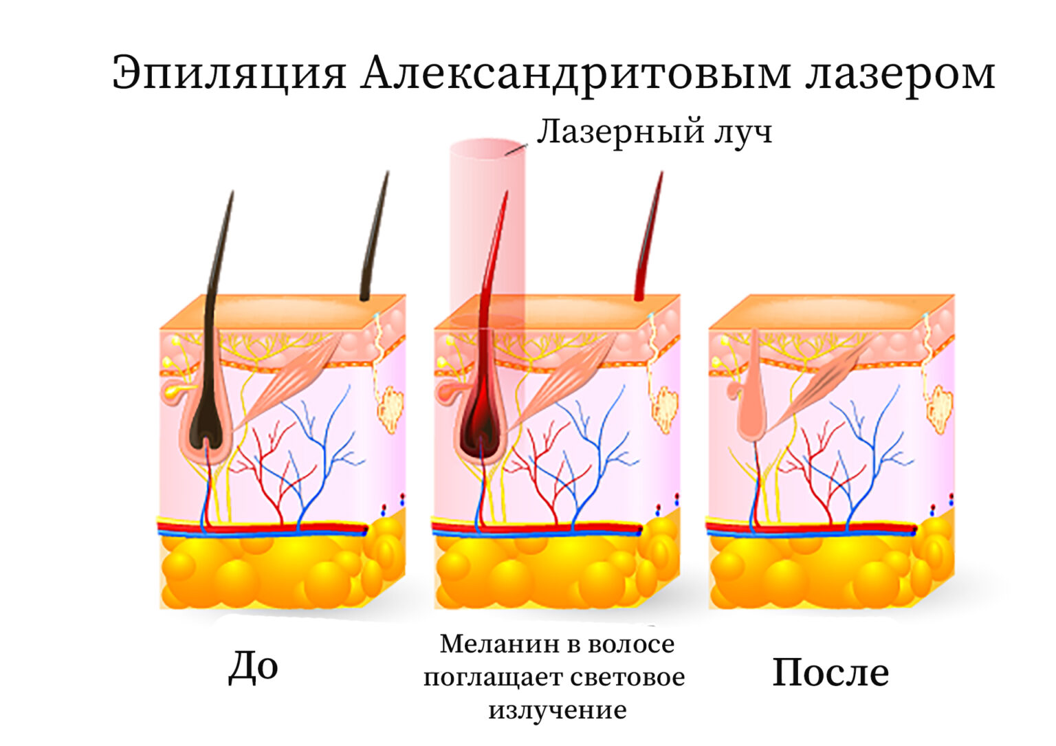 Эпиляция бикини картинки