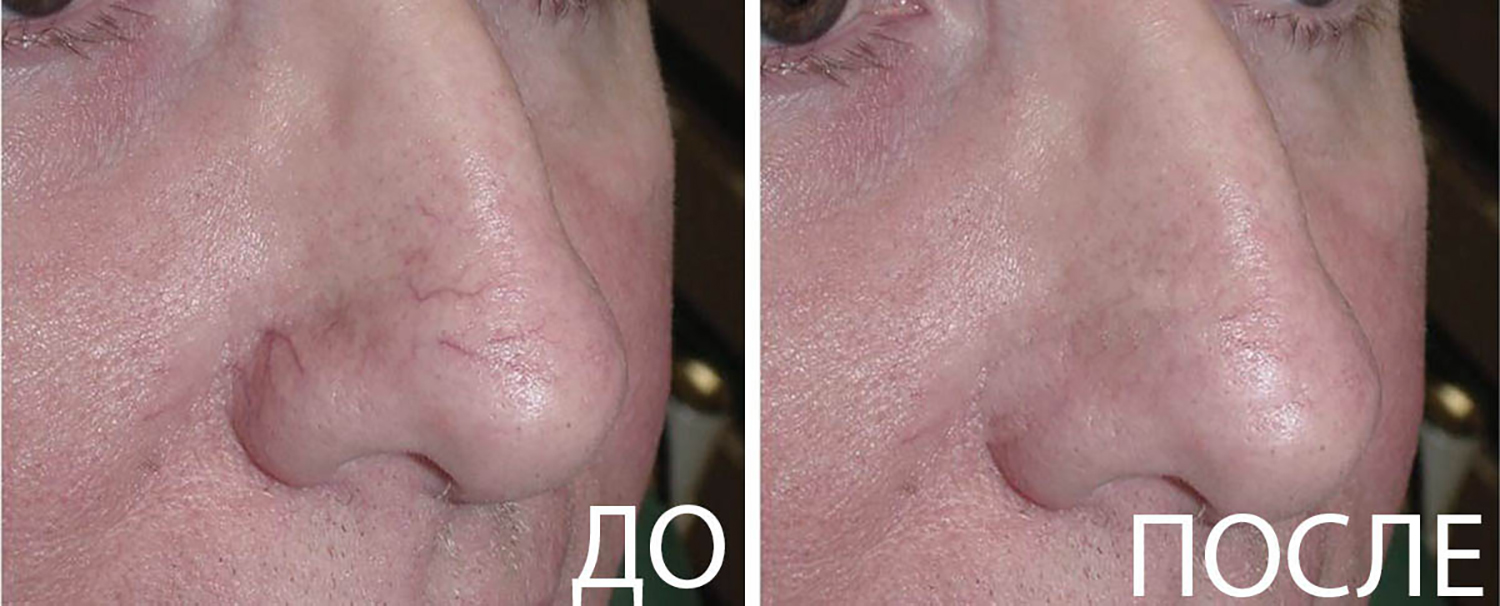 Сосуды на носу до и после
