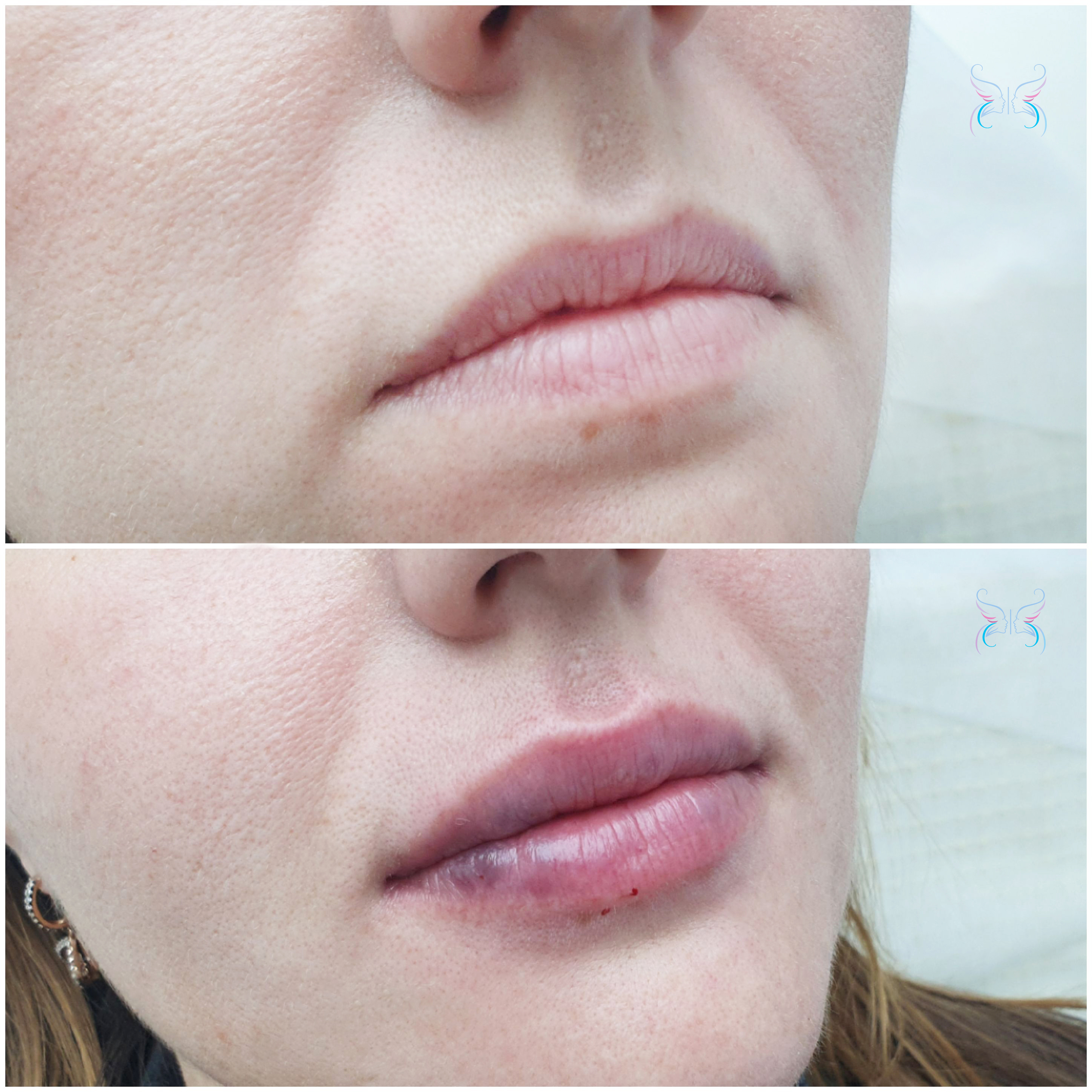 Отек губ после увеличения (аугментации) гиалуроновой кислотой | Клиника  Отражение