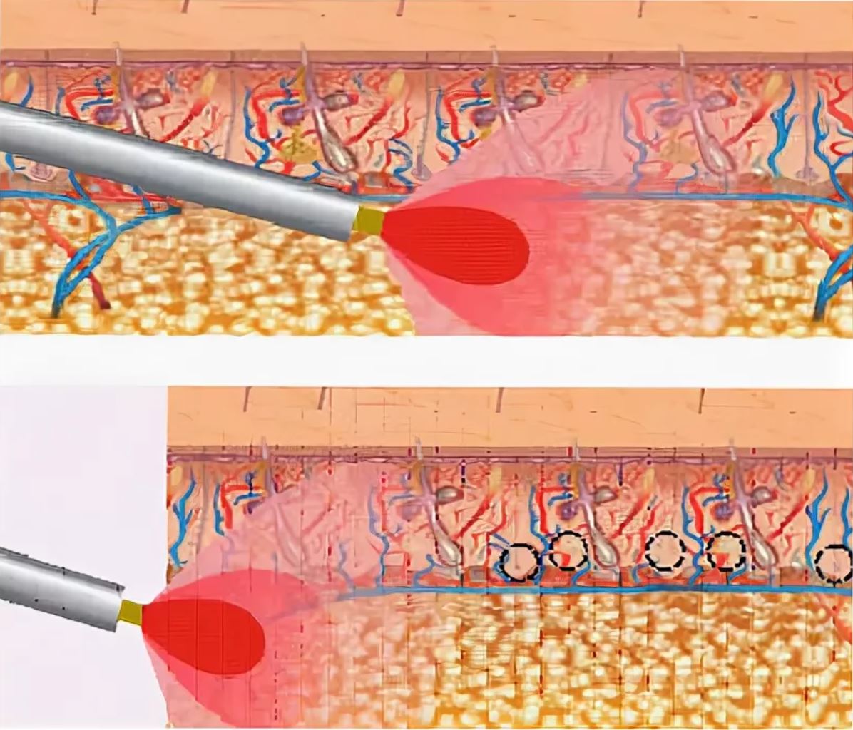 Разрушить потовые железы можно также при помощи неодимового лазера - лечение гипергидроза