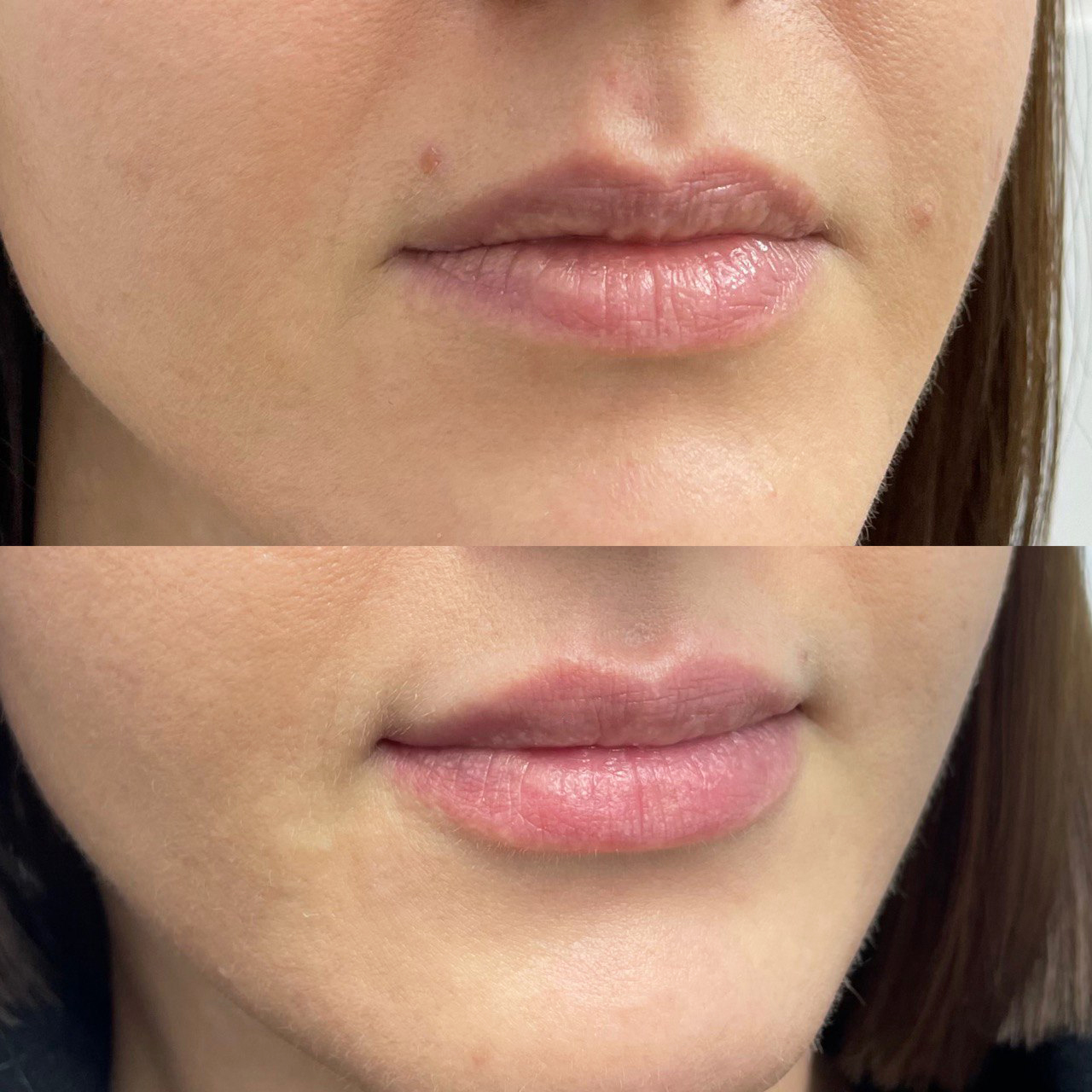 Контурная пластика губ. До/После. Врач Романова Анна.