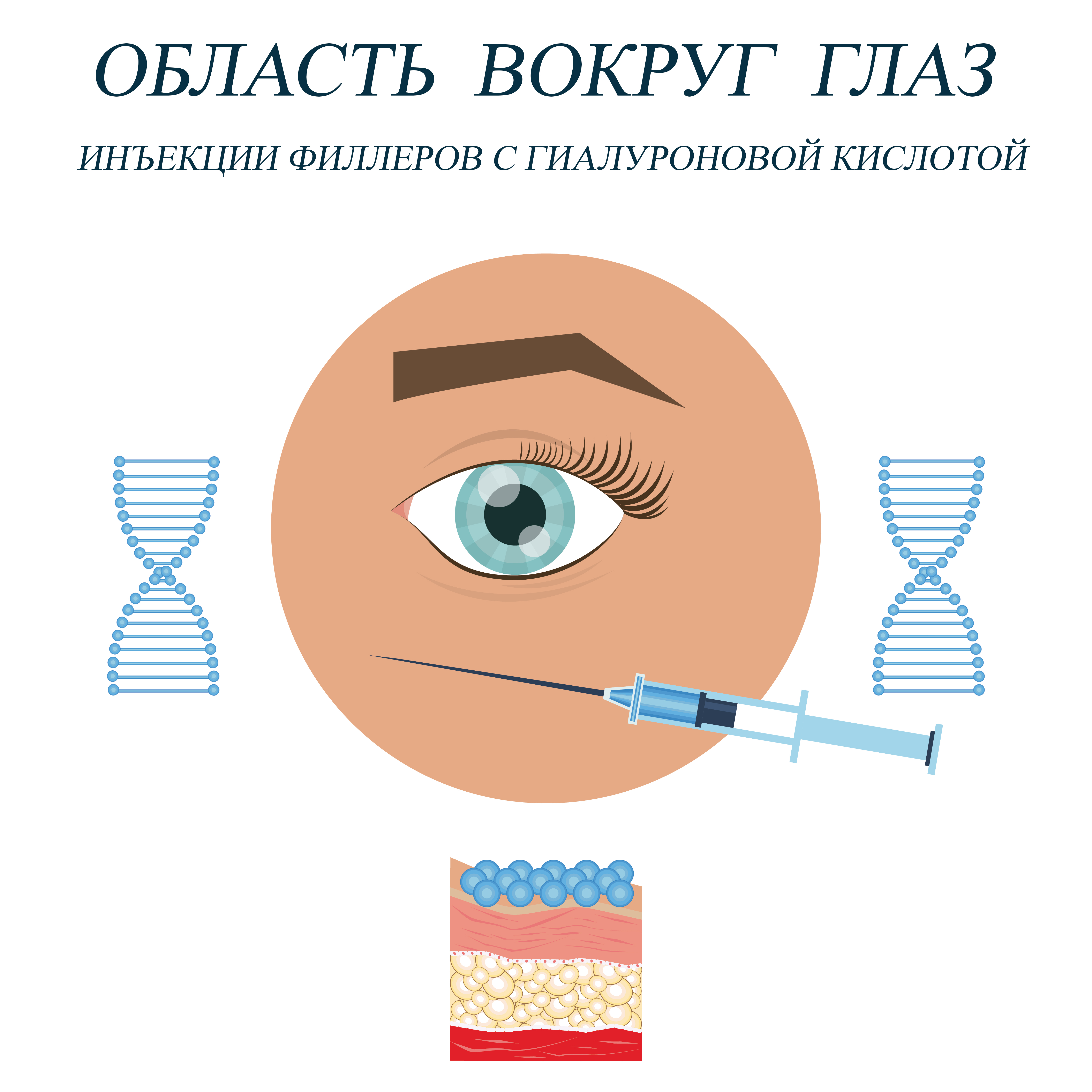 Филлеры на основе гиалуроновой кислоты. Область вокруг глаз. Можно устранить «гусиные лапки» в уголках глаз, а также избавиться от выраженной носослезной борозды и «синяков» под глазами. 