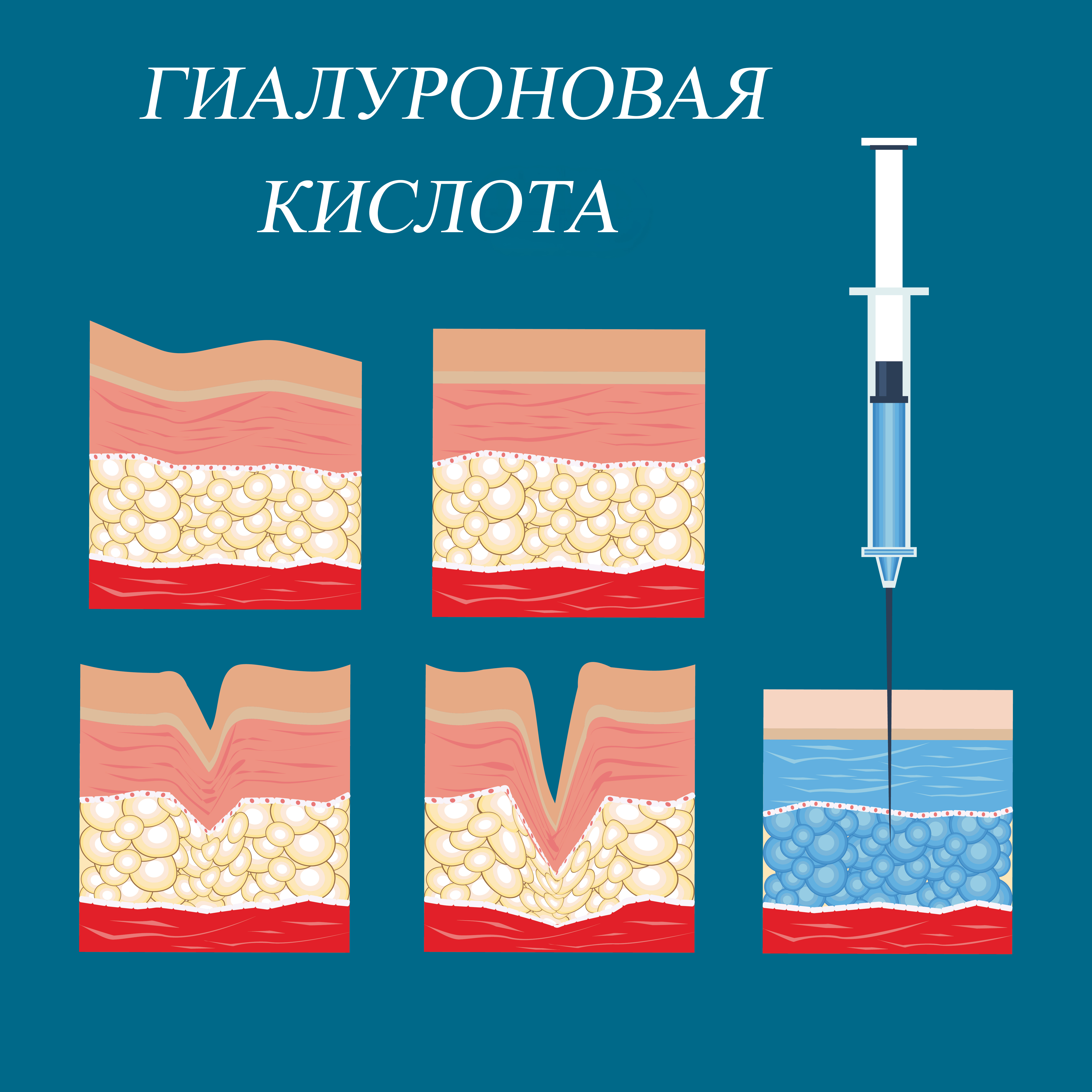 Филлеры на основе гиалуроновой кислоты