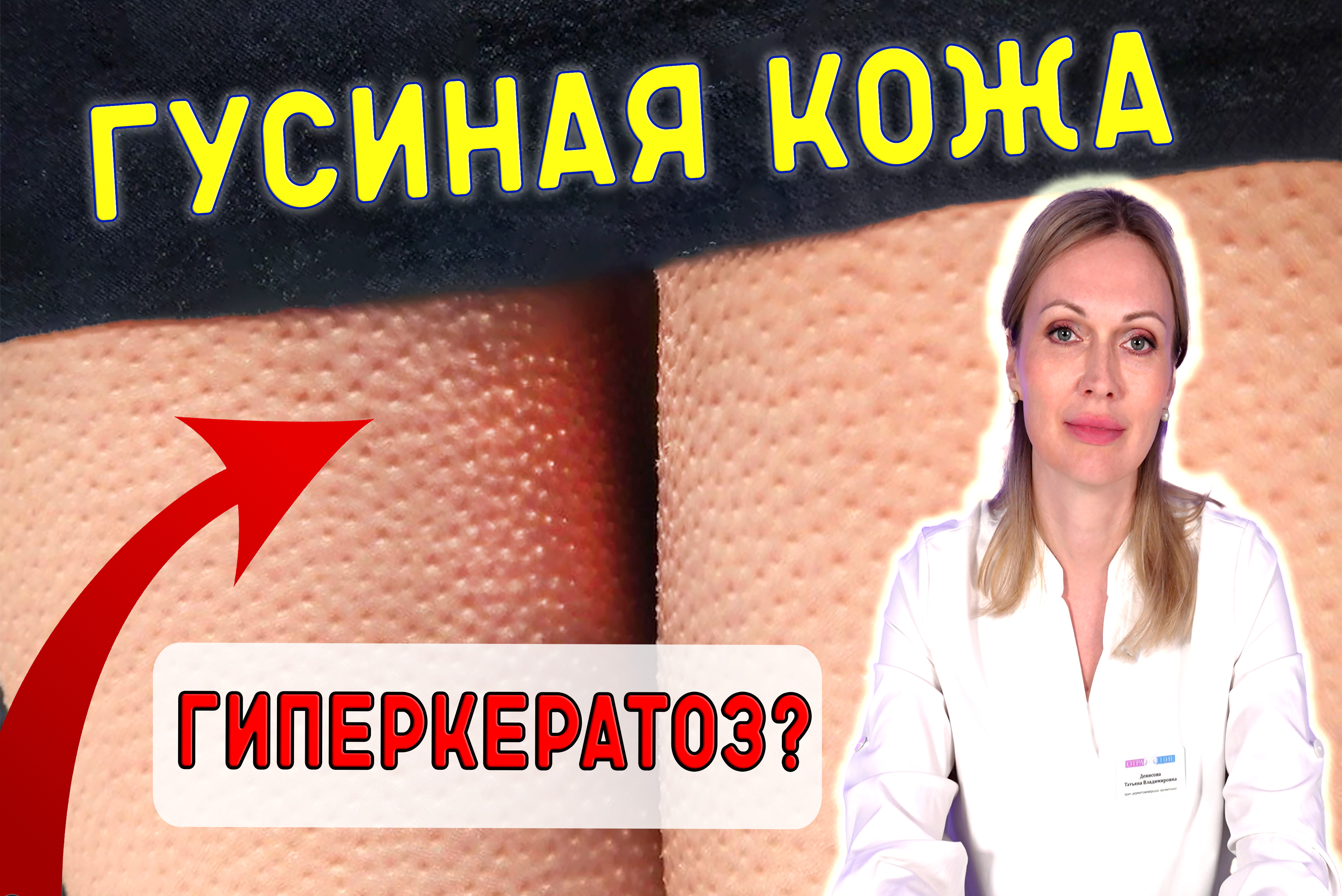 ГИПЕРКЕРАТОЗ – ЭТО ОПАСНО? Как в домашних условиях ухаживать за гусиной кожей