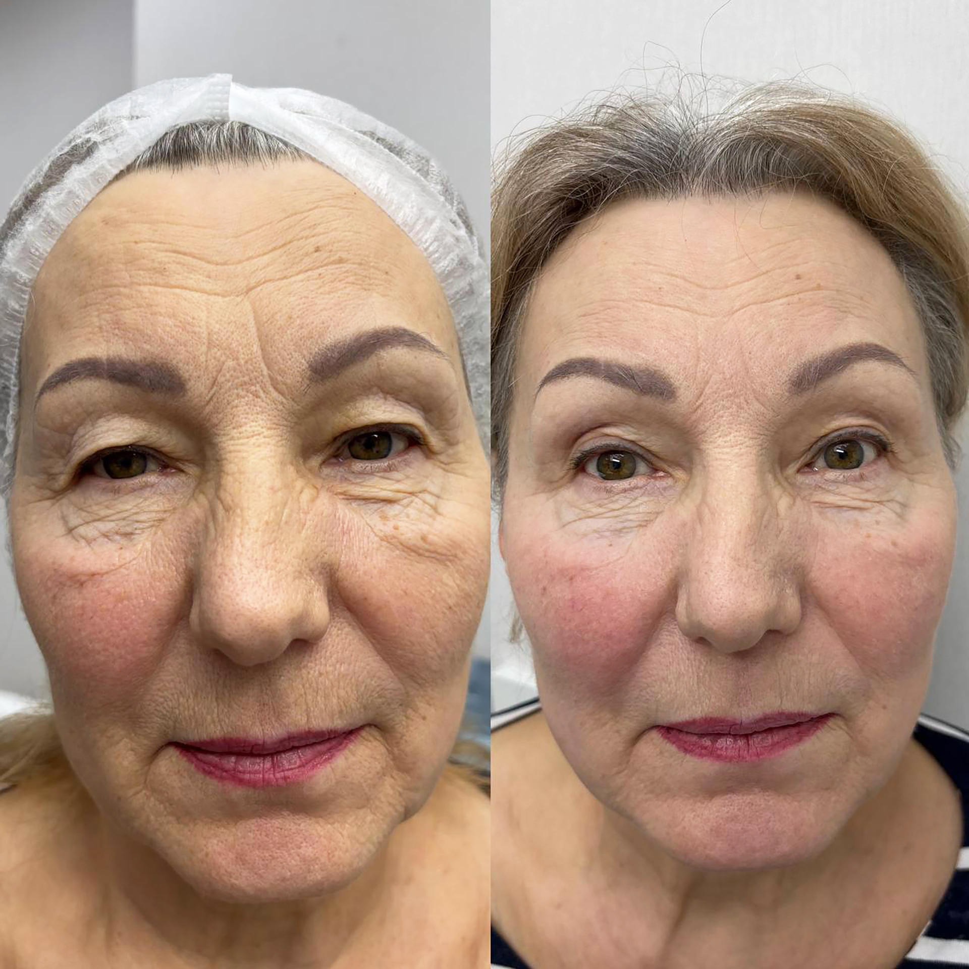 Эффект лазерной шлифовки Эффект лазерной шлифовки