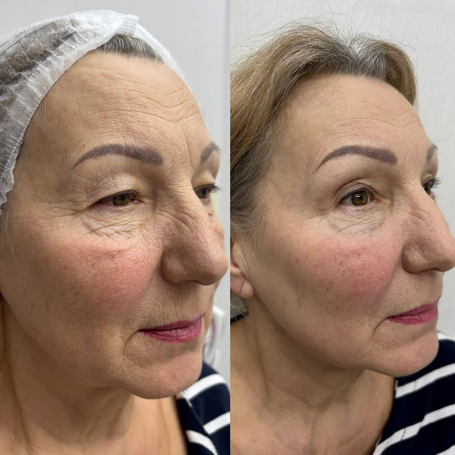 Эффект лазерной шлифовки Эффект лазерной шлифовки