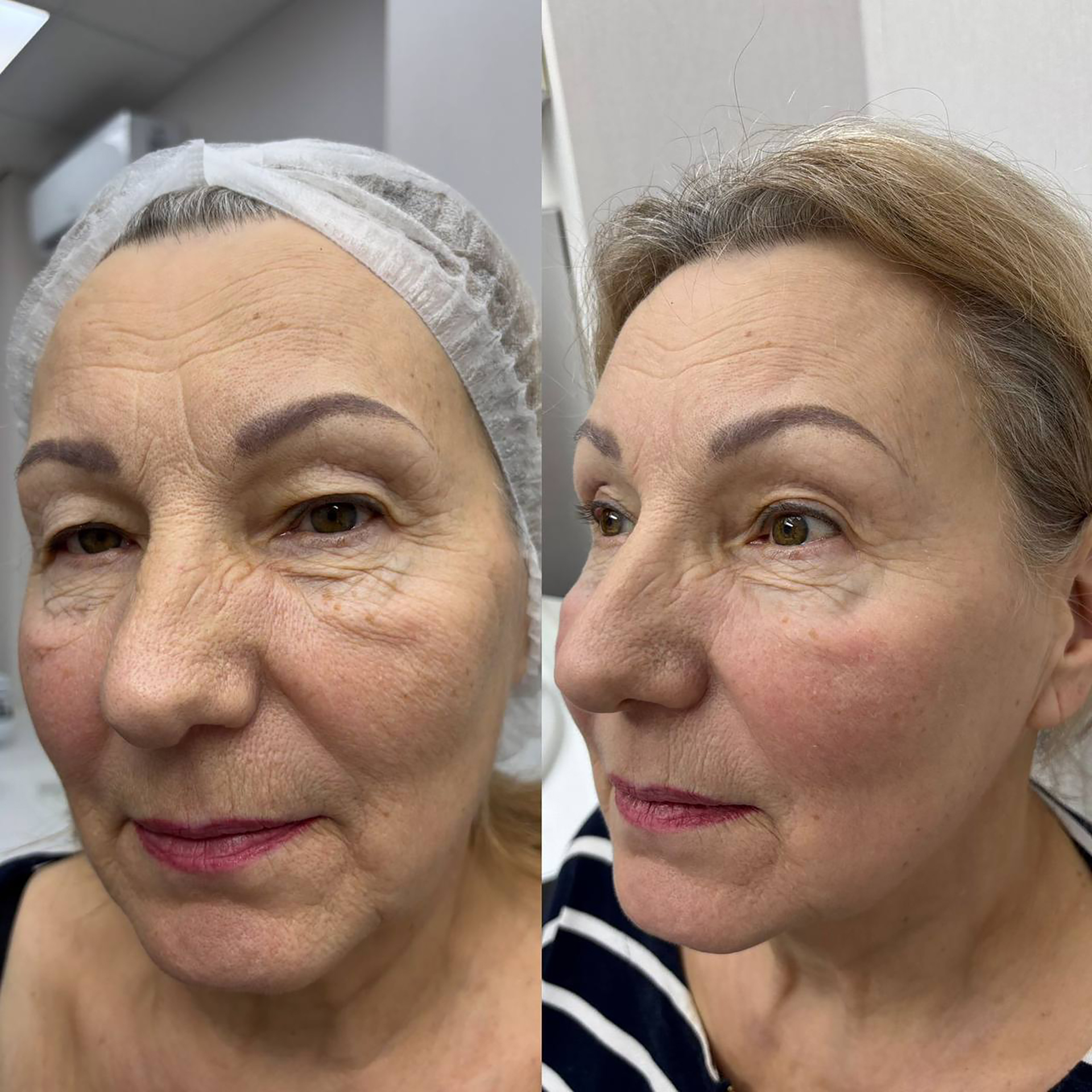 Эффект лазерной шлифовки