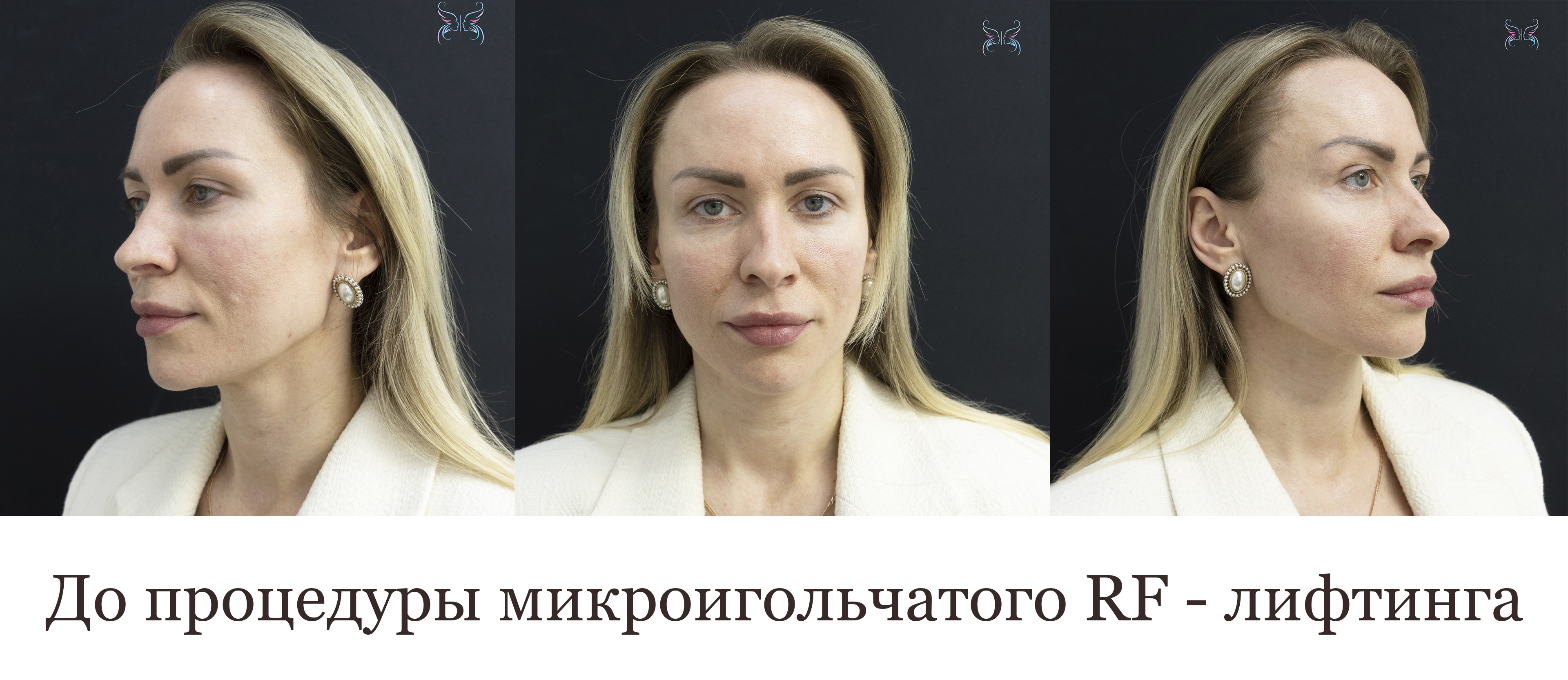 До процедуры микроигольчатого RF - лифтинга