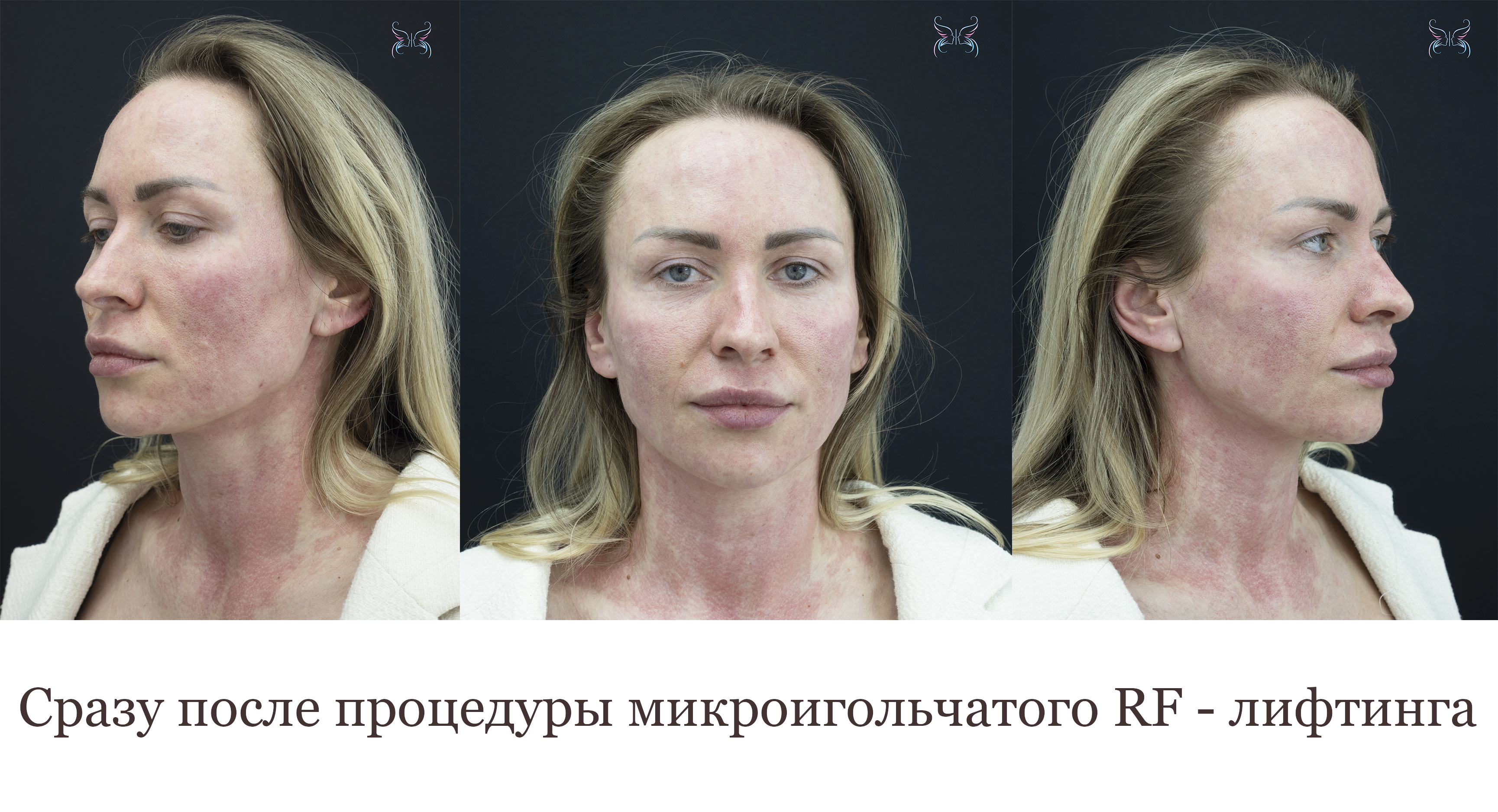 Сразу после процедуры микроигольчатого RF - лифтинга