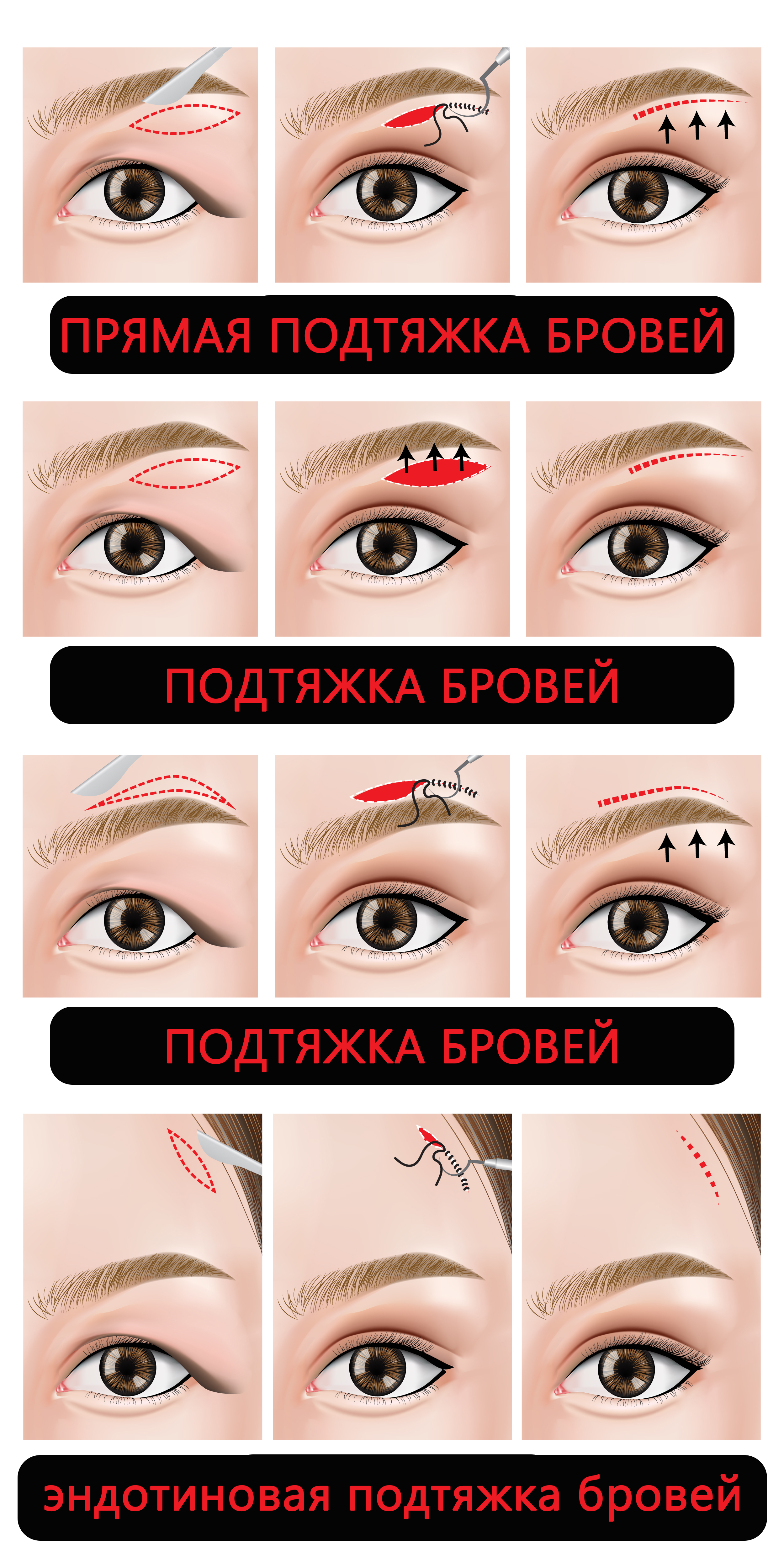 Подтяжка бровей