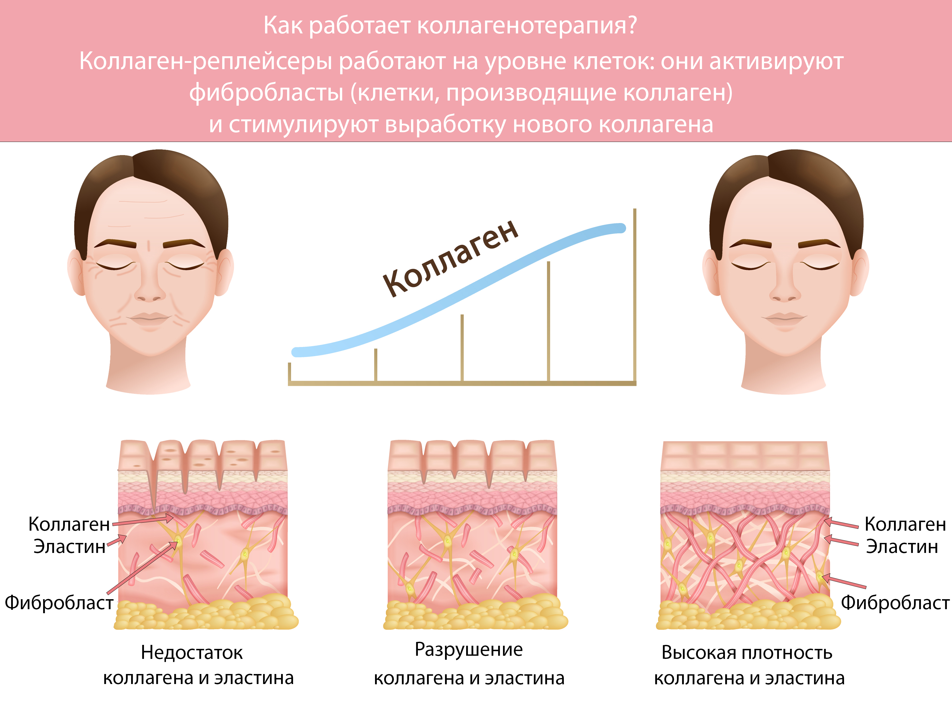 Коллагеновое омоложение - Как работает коллагенотерапия? Коллагеновое омоложение - Как работает коллагенотерапия?