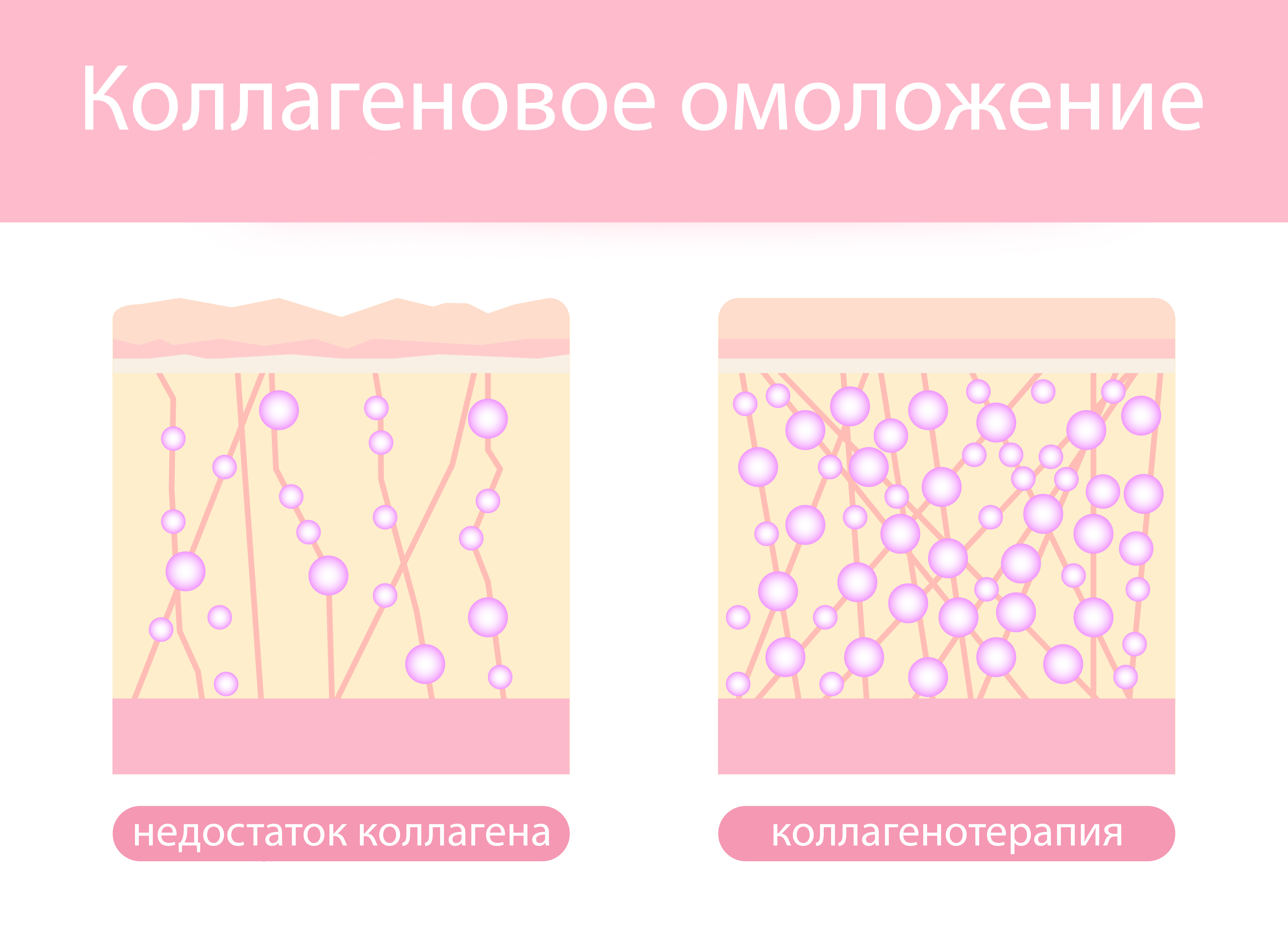 Коллагенотерапия Коллагенотерапия