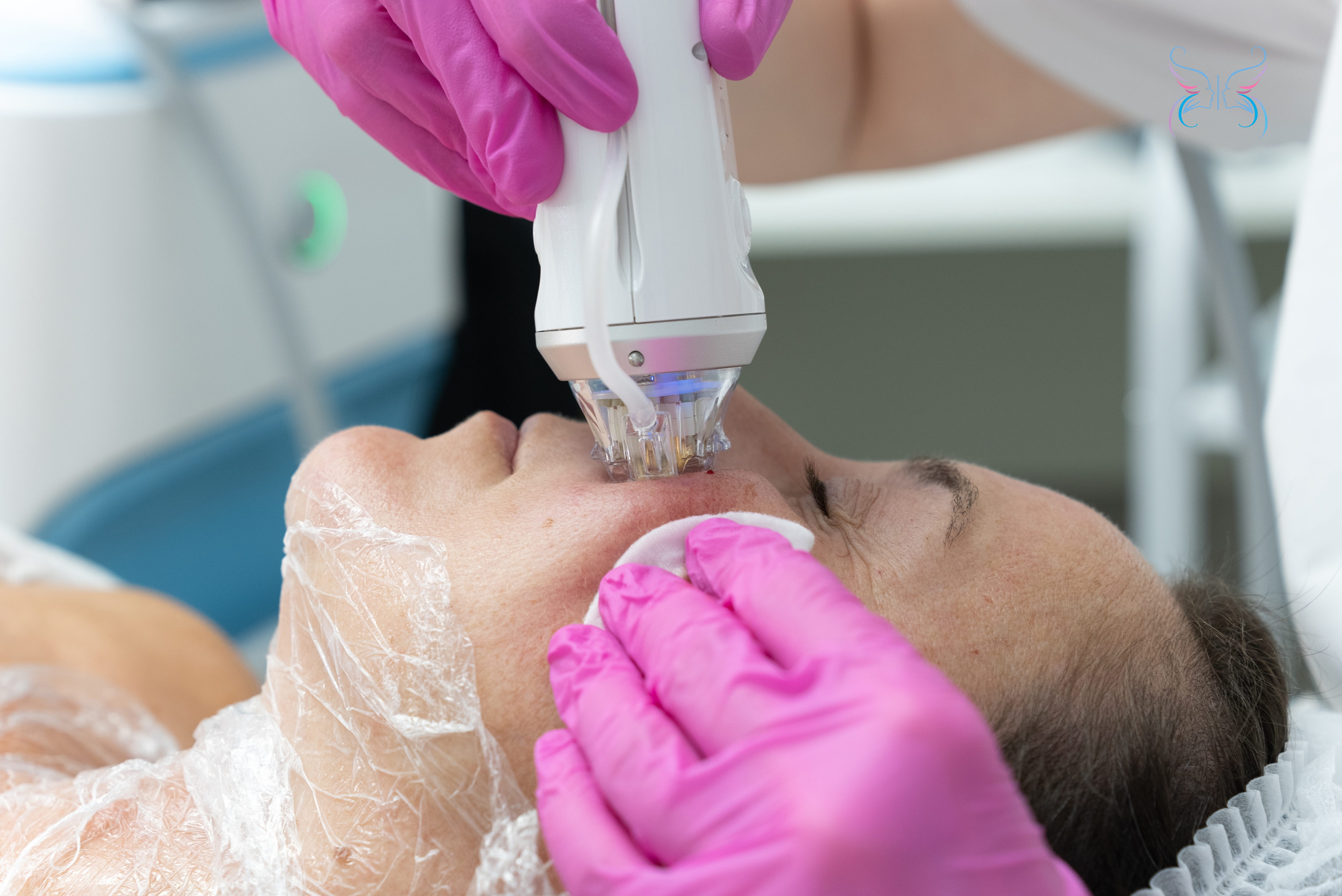 Процедура микроигольчатого РФ-лифтинга