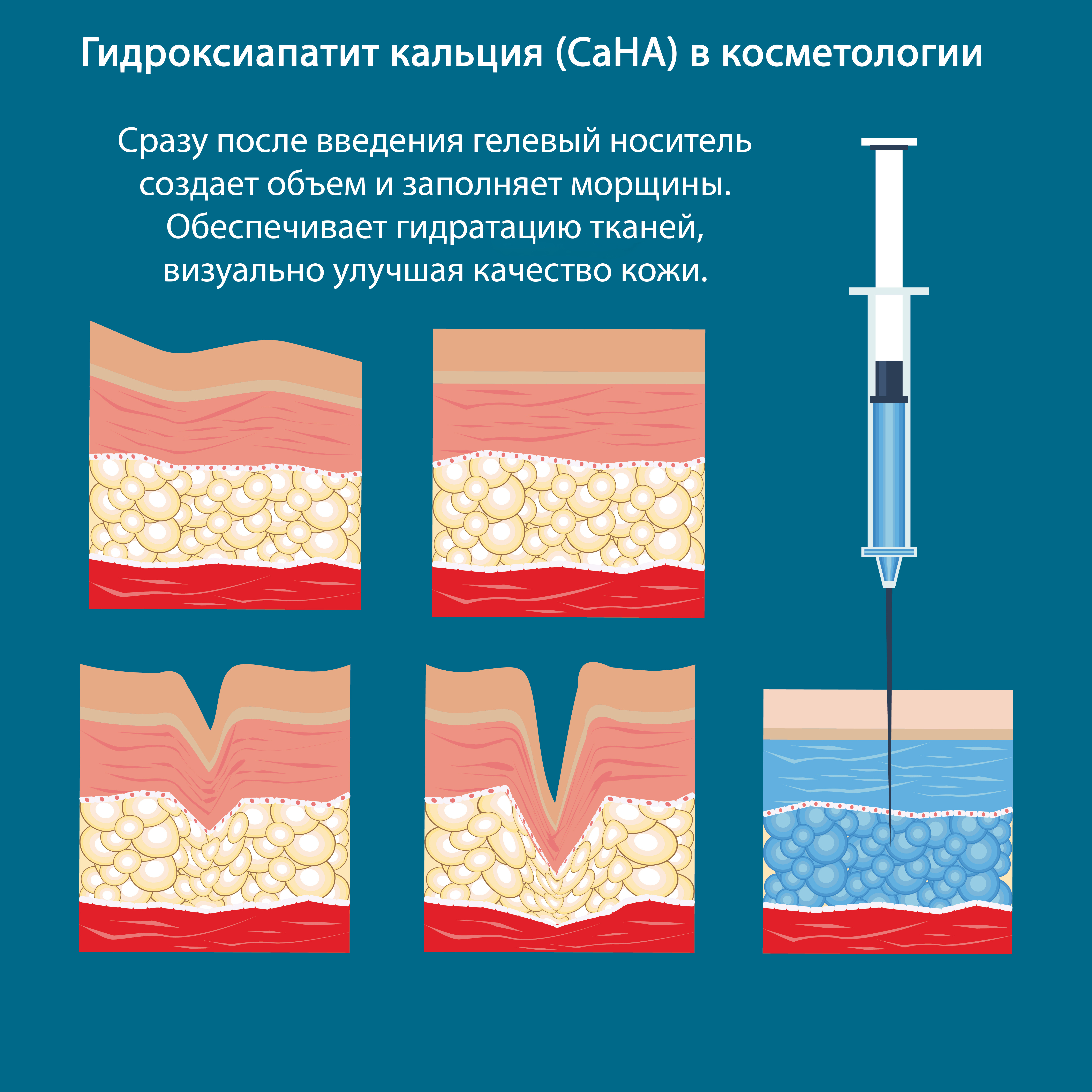 Сразу после введения гелевый носитель создает объем и заполняет морщины. Водная составляющая геля обеспечивает гидратацию тканей, визуально улучшая качество кожи.