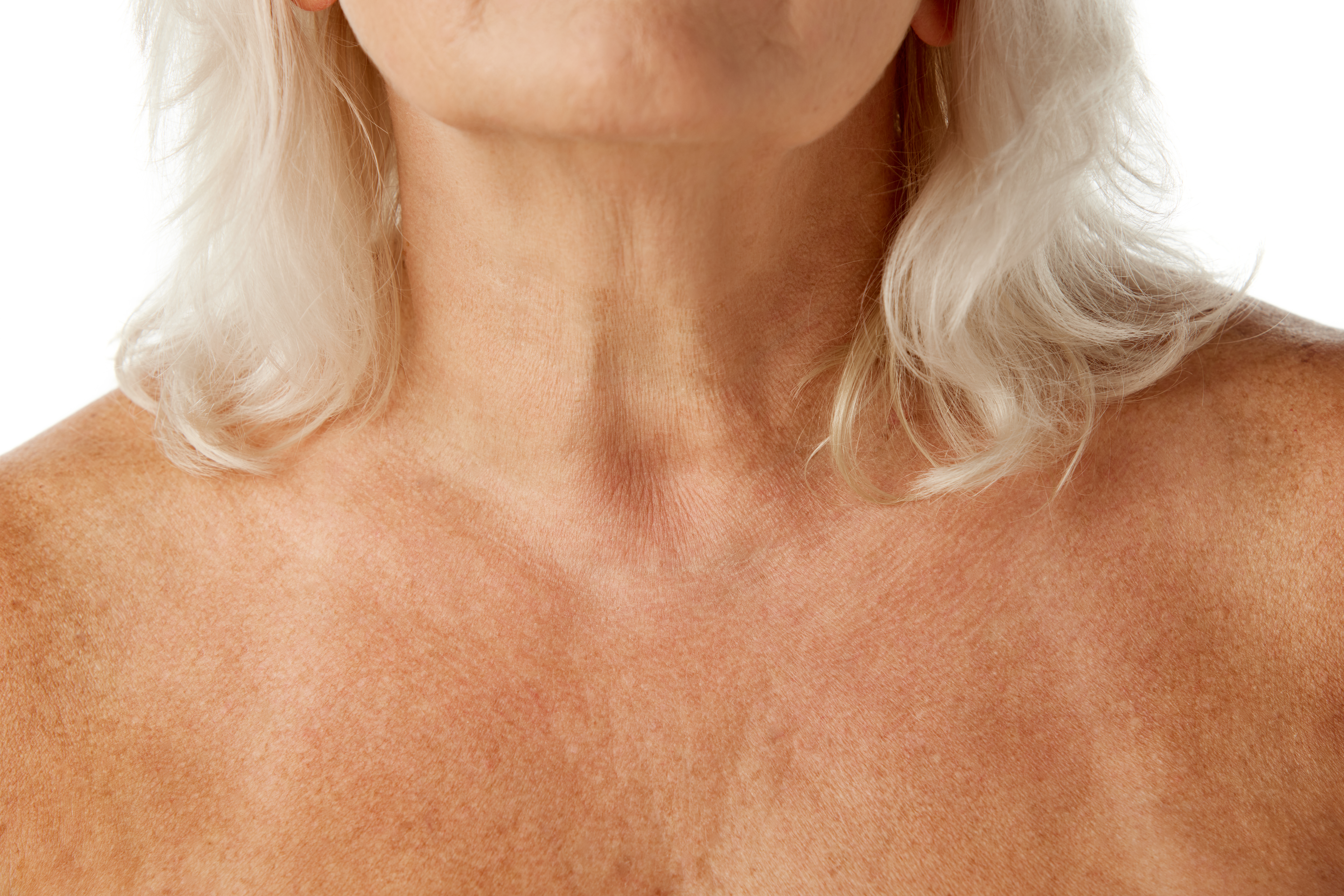 Дряблость кожи шеи, морщины в области декольте