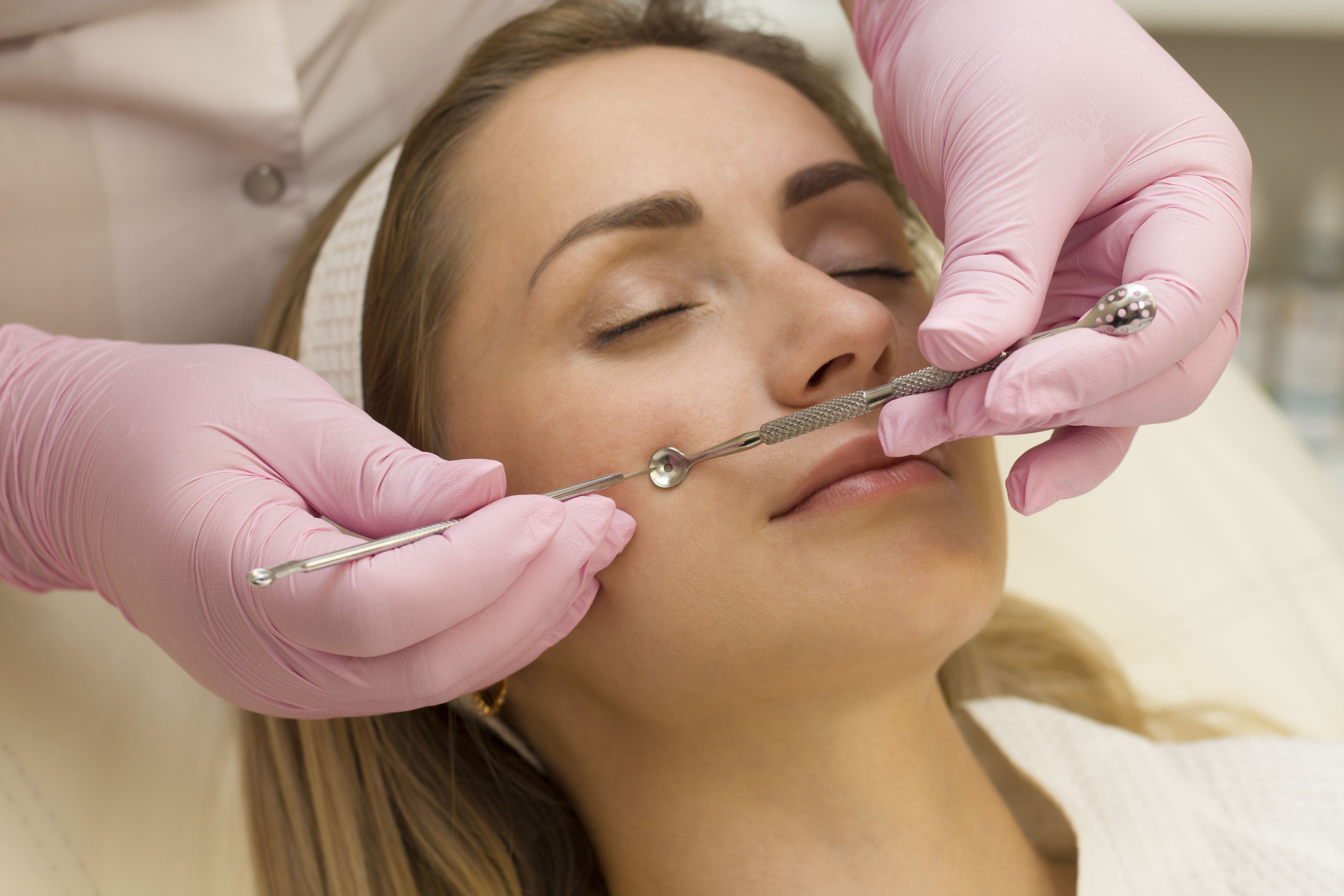 Проведение дерматологической чистки