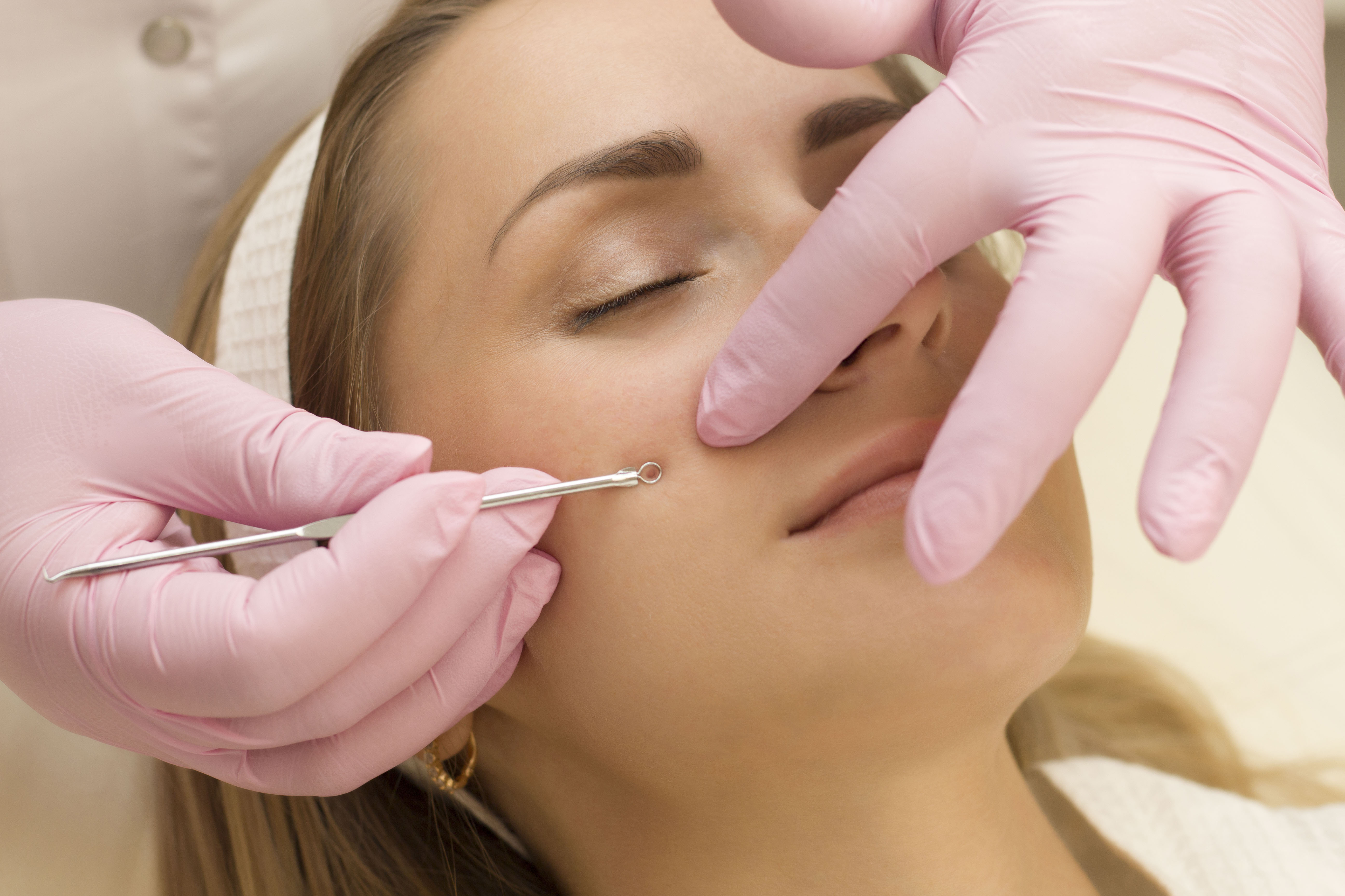 При механической чистке косметолог надевает стерильные перчатки, использует специализированные инструменты (иглу Видаля, ложку Уно, комедоновый экстрактор) для вскрытия закрытых комедонов и удаления содержимого пор