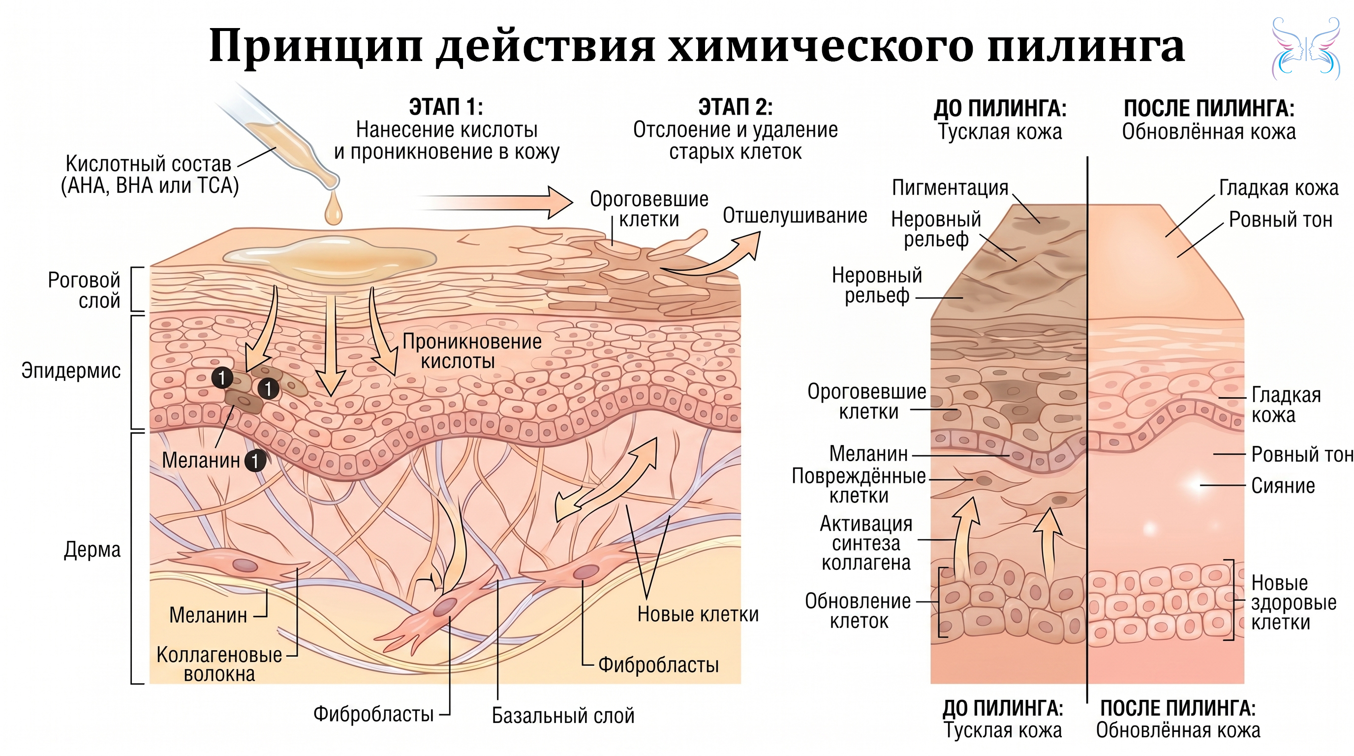 Принцип действия химического пилинга