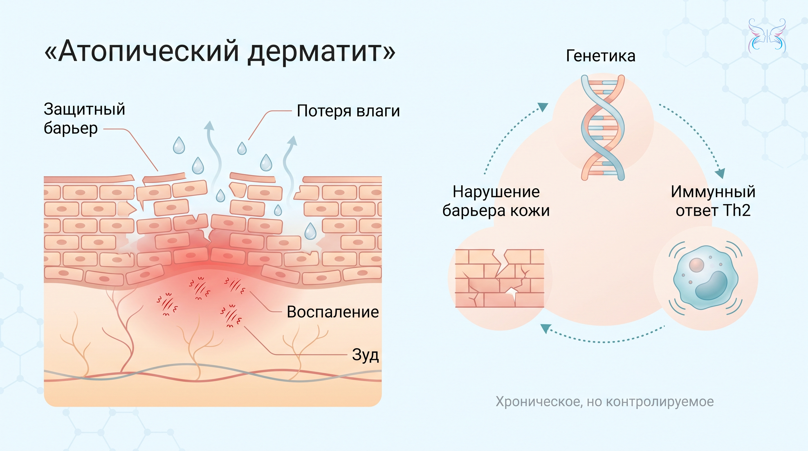 Атопический дерматит Атопический дерматит